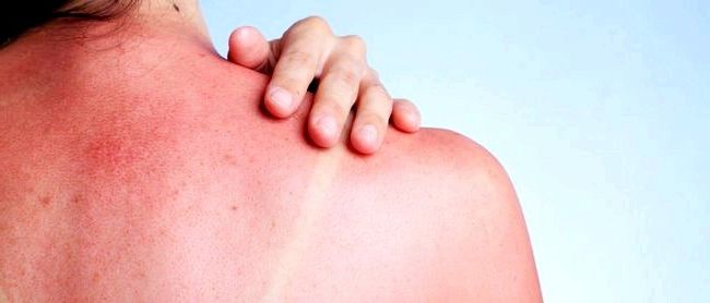 Аллергия на солнце: лечение народными средствами