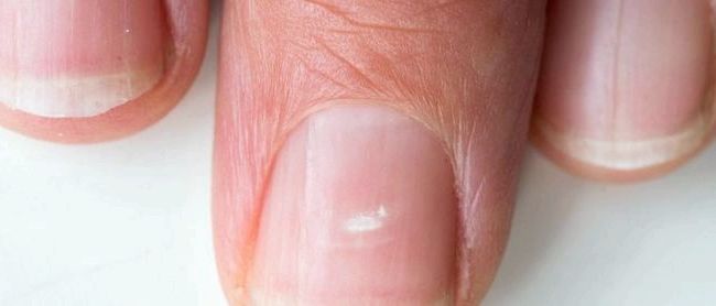 Проблемы с ногтями, которые вы должны знать